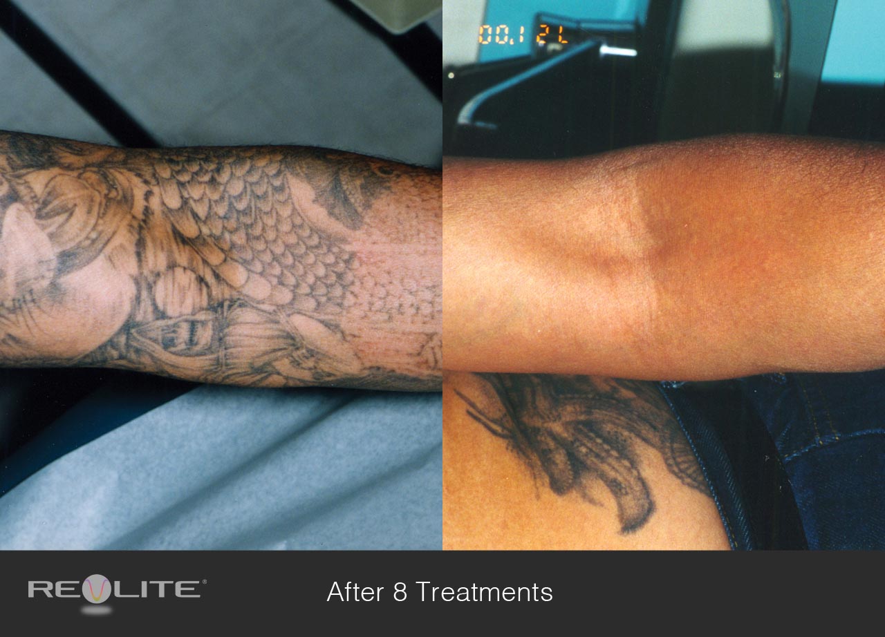 1. Laser Tattoo Removal - wide 5