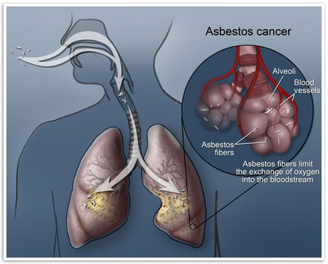 asbestos-cancer