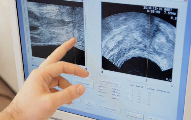 prostate-cancer-ultrasound