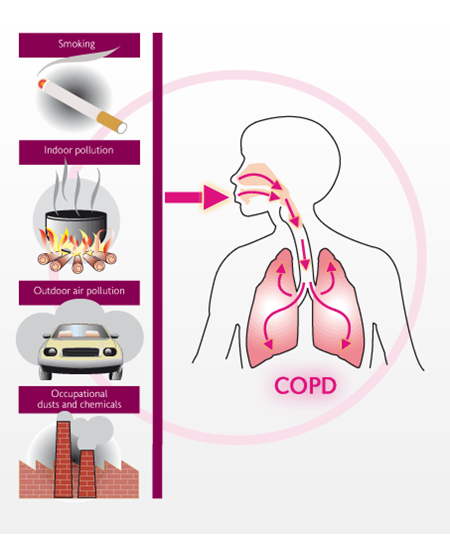 gold guidelines copd