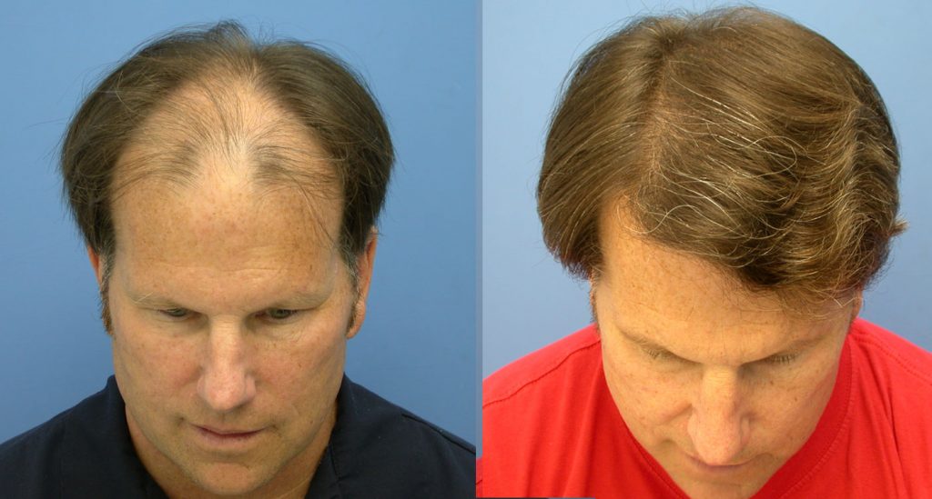 reivew-of-hasson-and-wong-hair-transplant-bill