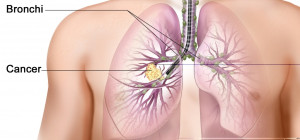 The Connection Between Smoking & Lung Cancer