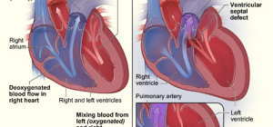 Ventricular Septal Defect - Causes, Diagnosis, and Treatment Methods in India
