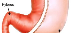 Laparoscopic Sleeve Gastrectomy: Why You Should Go for the Surgery