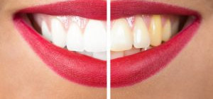 How can you get whiter teeth naturally?