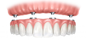 Benefits of Ceramic Dental Implants for the Elderly