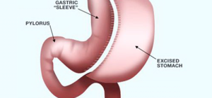 Advantages of Sleeve Gastrectomy or Restrictive Weight Loss Surgery