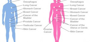 Battle with Cancer-Types of Surgeries