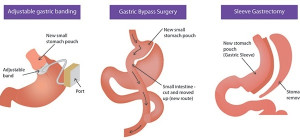 The Pros and Cons of Weight Loss Surgery