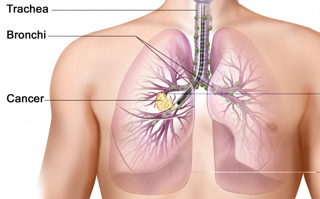 The Connection Between Smoking & Lung Cancer