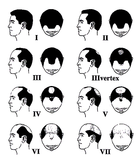 The Norwood Hair Loss Classification System categorizes types of mail pattern baldness.