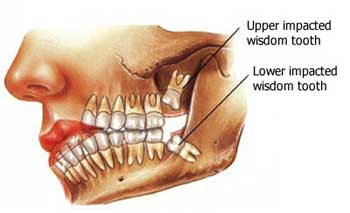 Do You Really Need Your Wisdom Tooth Removed?