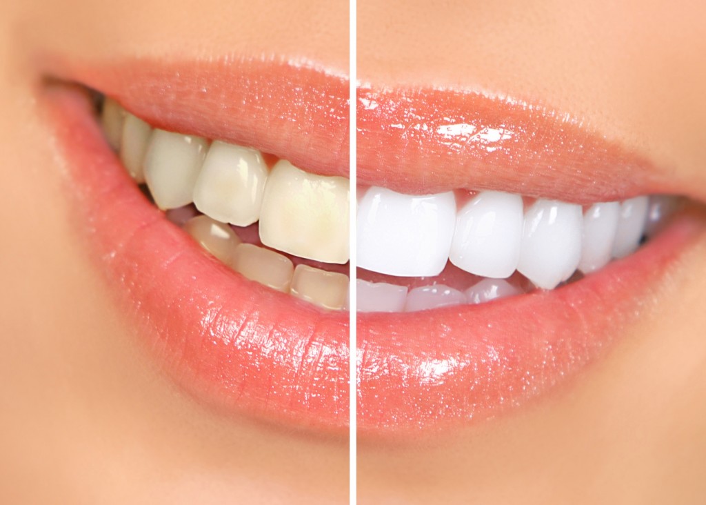 Five Steps to Whiter Teeth