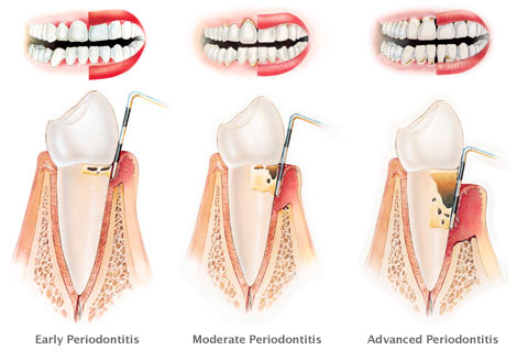 Periodontitis-Symptoms, Treatment and Prevention
