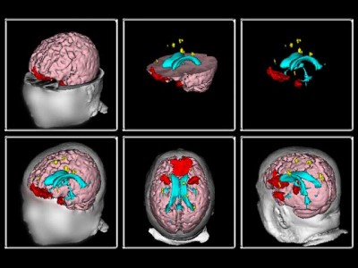 3D PDF Brain Imaging and Its Application in Court Trials
