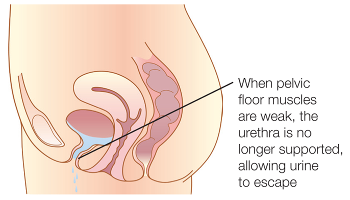 Treating Incontinence in the Elderly