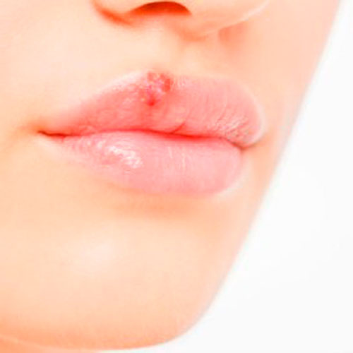9 Things You Ought To Know About Cold Sores.