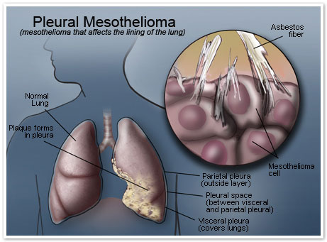 Understanding Mesothelioma and Related Treatments