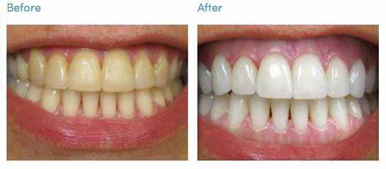 How to Safely Whiten Teeth Using Hydrogen Peroxide