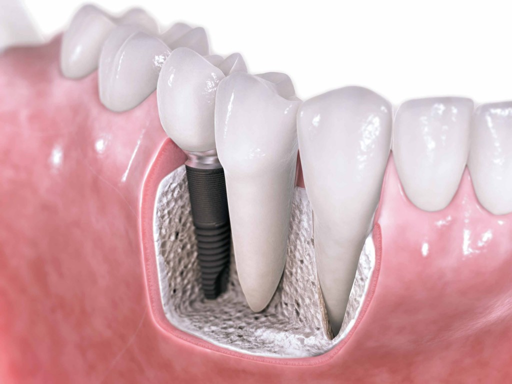 Teeth Implantation - Is this Really Possible?