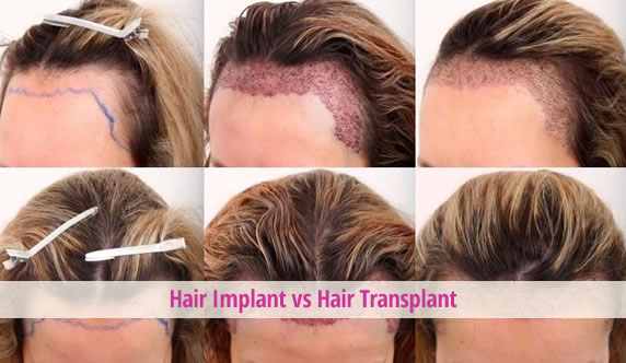 Importance of hair implantation treatment