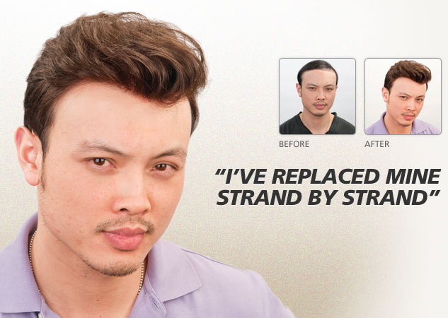 Types Of Hair Transplants Offered In A London Hair Transplant Clinic