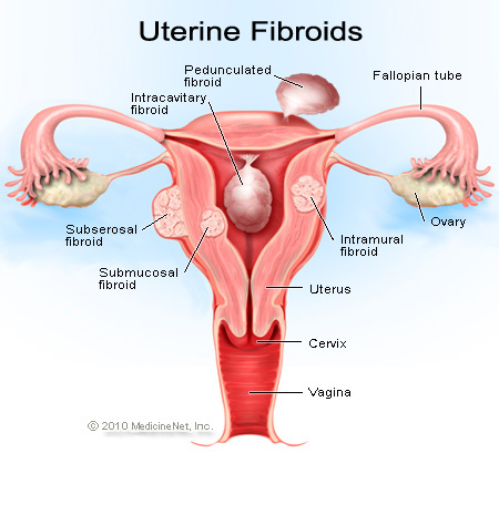 Overview : Types of Uterine Fibroid, Causes and Treatment