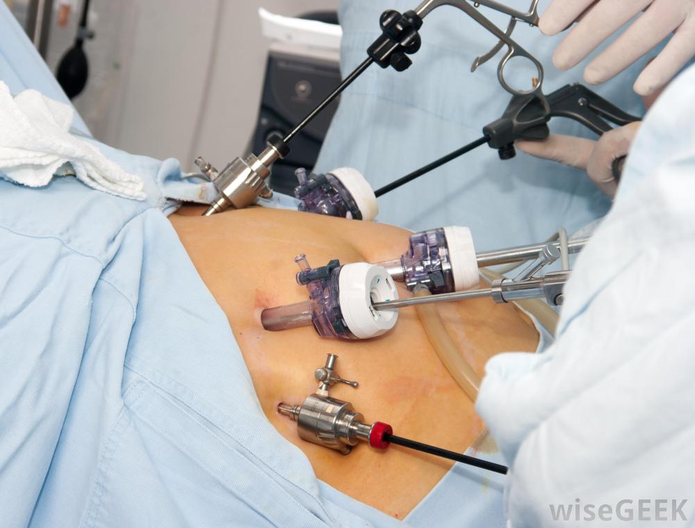 Laparoscopic Surgery for Better Patient Outcomes