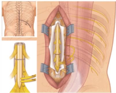 Spinal Cord Operation Success Rate in India