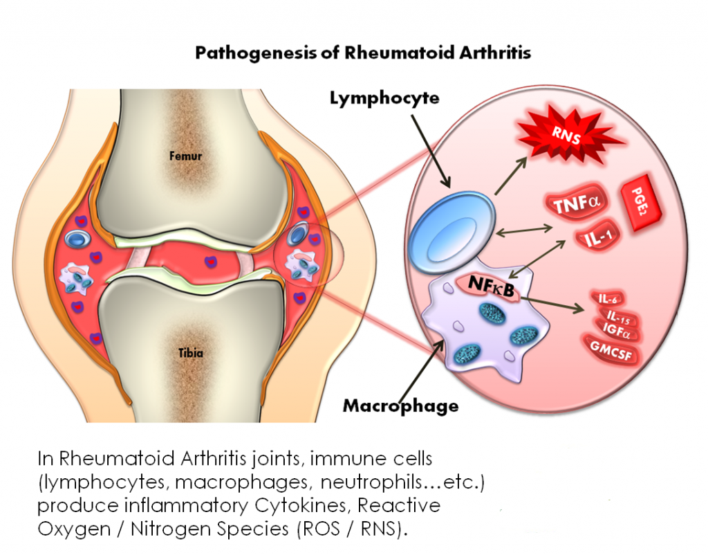 Rheumatoid Arthritis and Essential Safety Measures