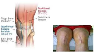 What are the Benefits of a Knee Replacement Surgery?