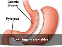 Laparoscopic Sleeve Gastrectomy: Why You Should Go for the Surgery