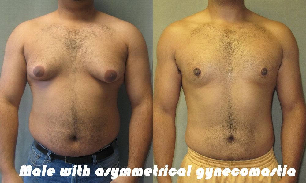 Male with Asymmetrical Gynecomastia