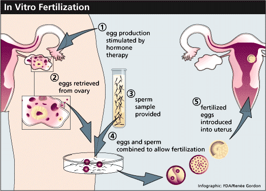 In Vitro Fertilization - How Does the Egg Donation Process Work?