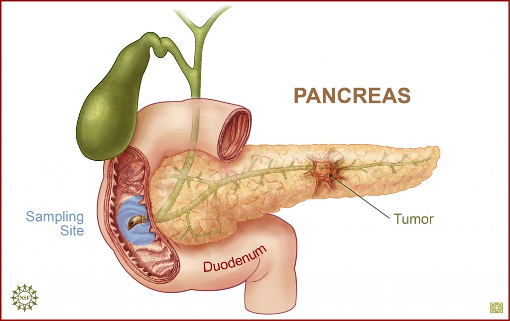 Pancreatic Cancer: Types and Treatment