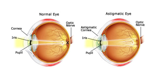 Various Treatment Options For Astigmatism