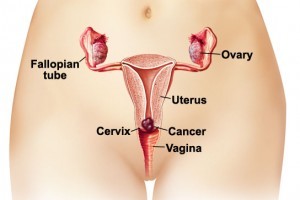 Cervical Cancer Treatment