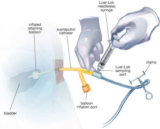 Простаты через уретру. Мочеотводной катетер. Катетер мочеточниковый Flexi-Tip Dual Lumen Ureteral access Catheter 022610.
