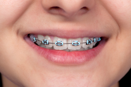 How to Convince Your Child to Wear Braces in 7 Ways