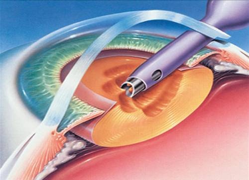 Cataract Surgery: Tips to a Speedy and Safe Recovery
