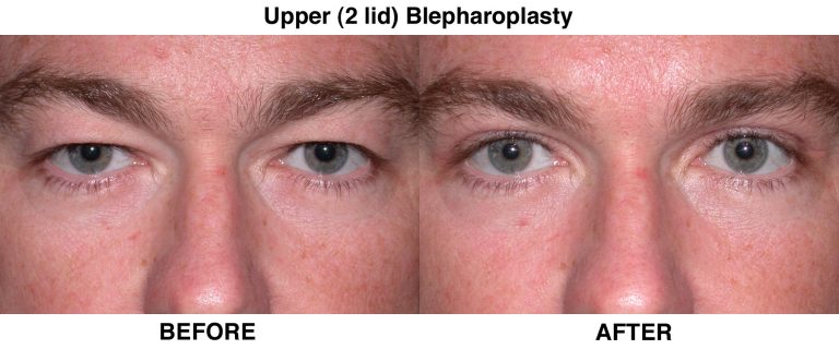 Blepharoplasty – An Overview