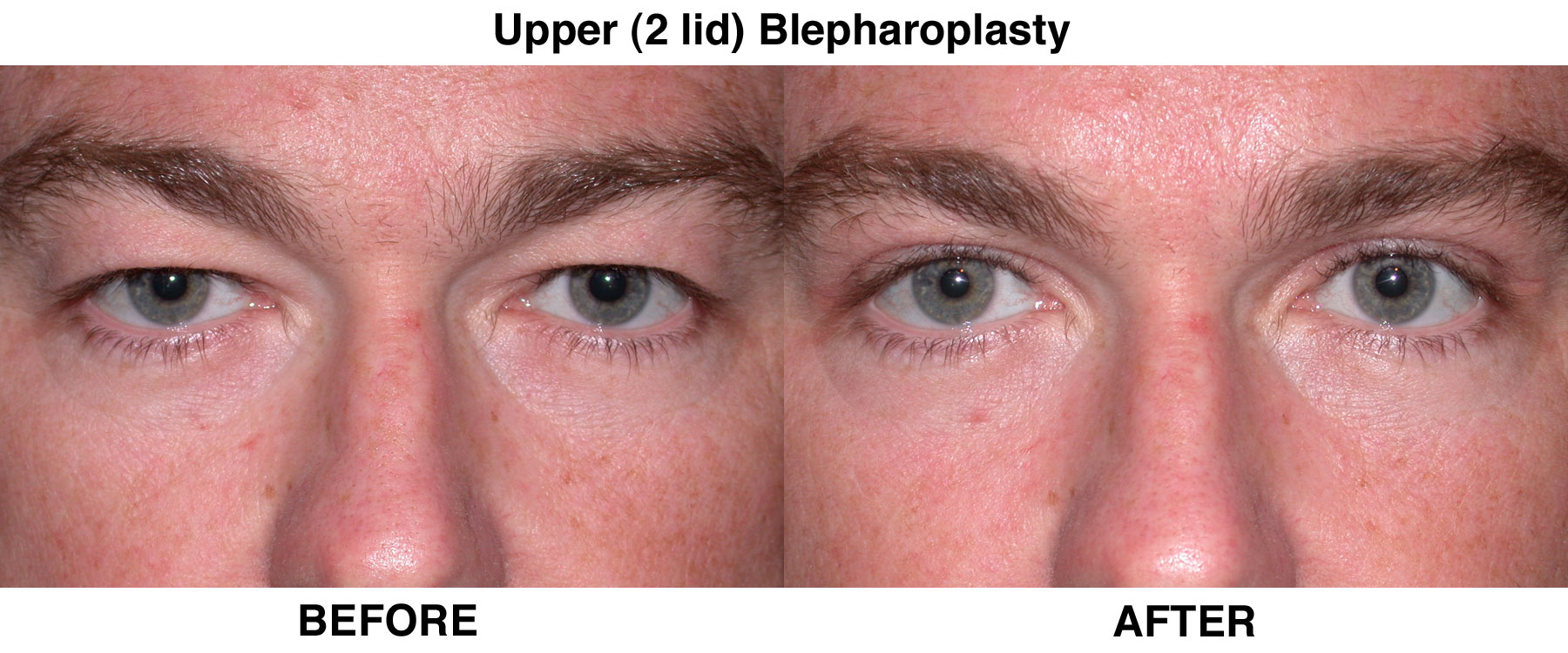 Черные глаза операция. Блефаропластика мужская. Мужская блефаропластика верхних век.