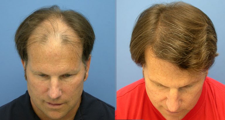 Fue hair transplant: a confirmed answer of hair loss