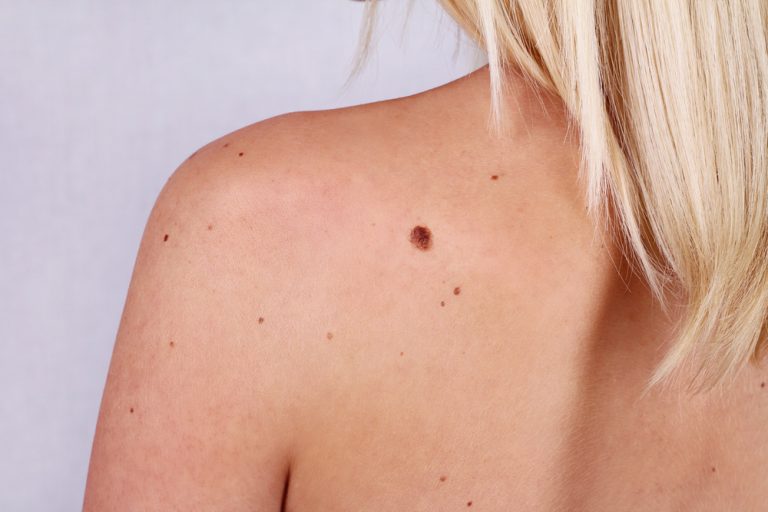 14 Natural Tips For Removing Moles On Your Skin