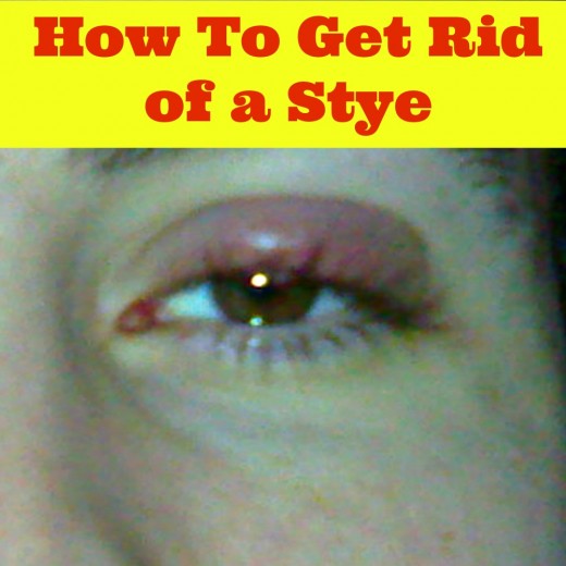 10 Natural Home Remedies for Stye In Your Eyes