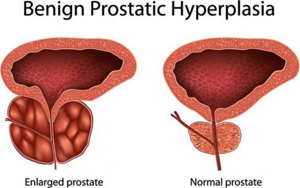 Understanding Cause Prostate Cancer – Symptoms