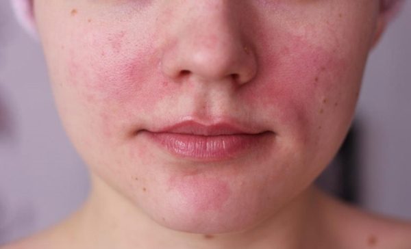 The Best Natural Face Moisturizers for Rosacea