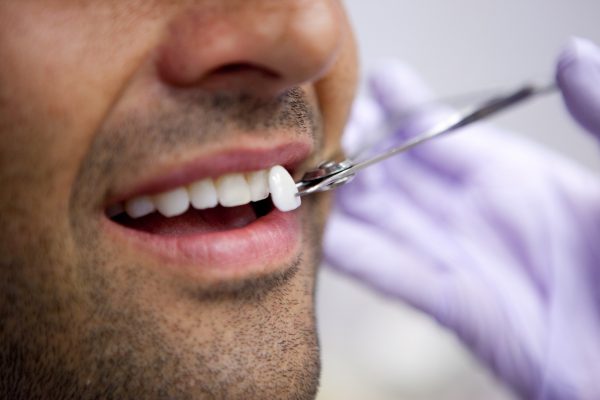 Dental Veneers vs. Dental Implants