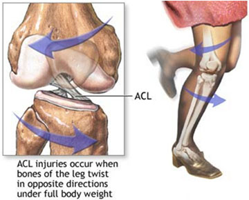 ACL Injuries and Surgery