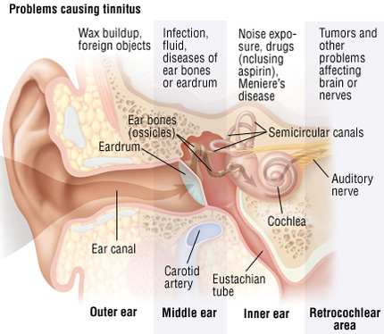 A Few Ways to Help Treat Your Tinnitus Condition